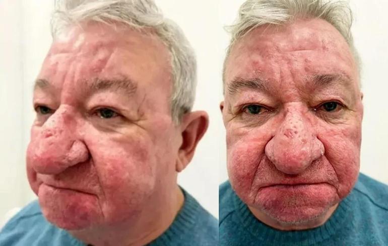 Burnu giderek büyüdü. 68 yaşındaki adam kabus gördü ve 4 saatlik operasyonla adeta yeniden doğdu.